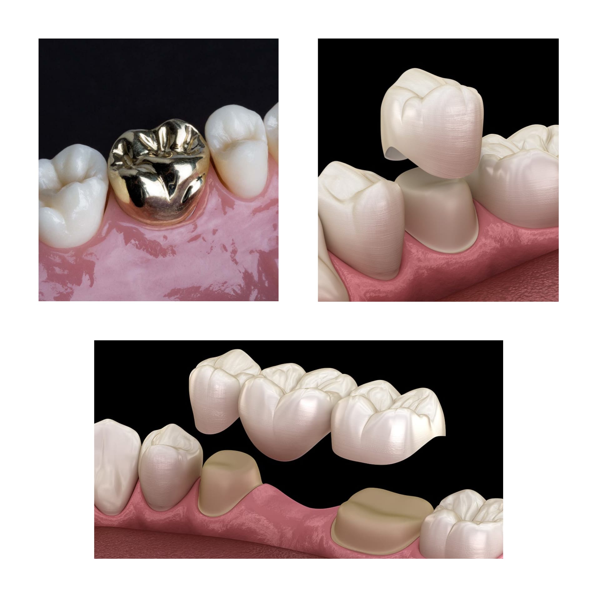 Gold Tooth